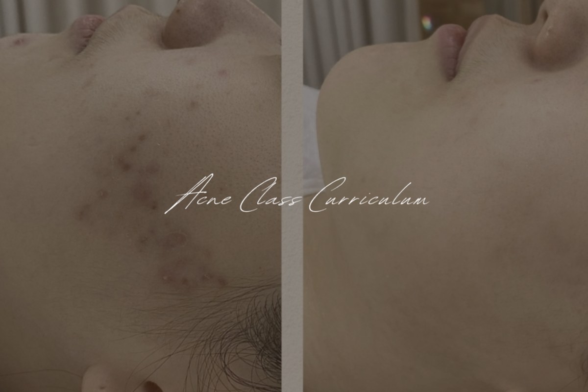 Intensive Acne Extraction Course (4 hours)