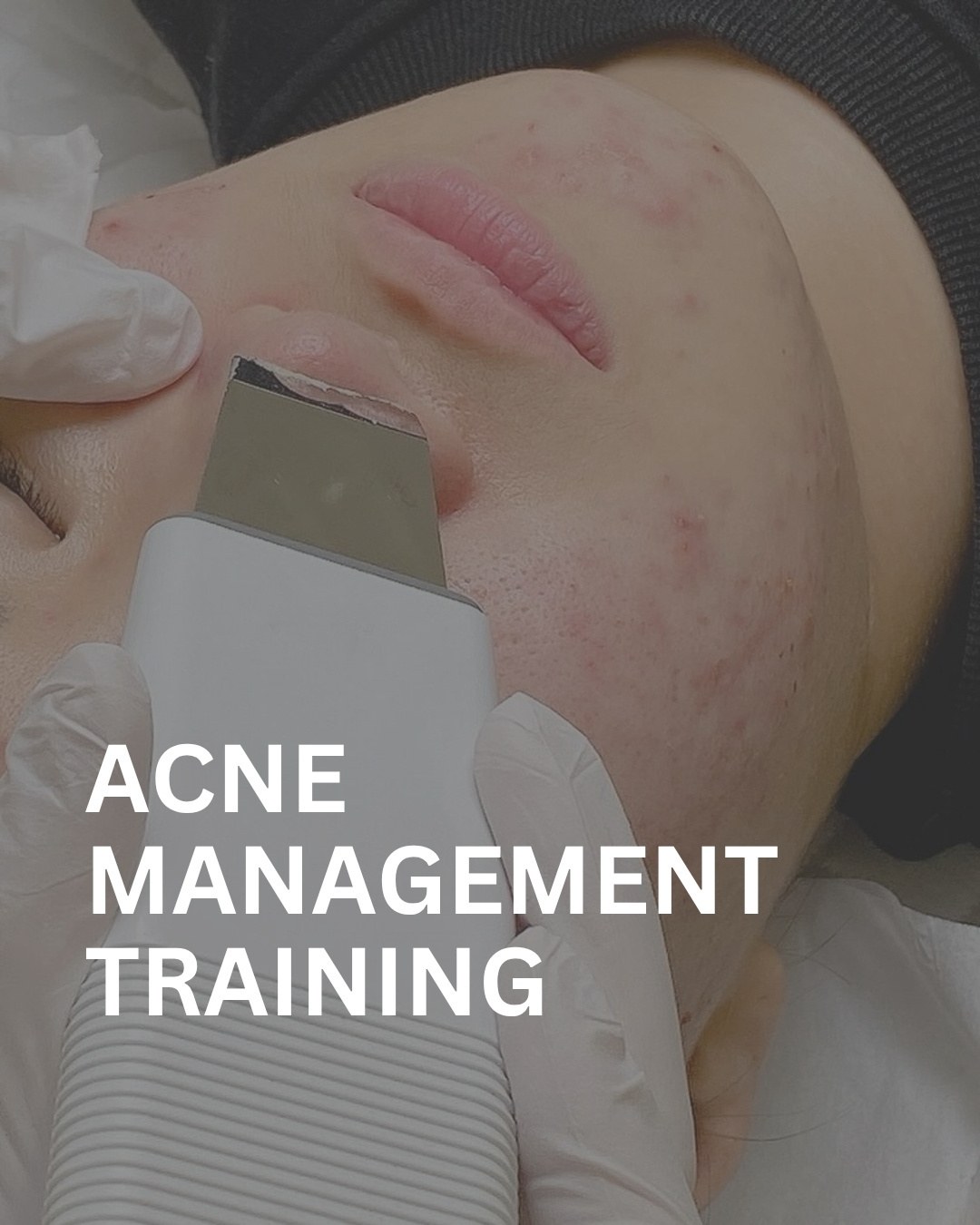 1:1 Hands-On Acne Care Program