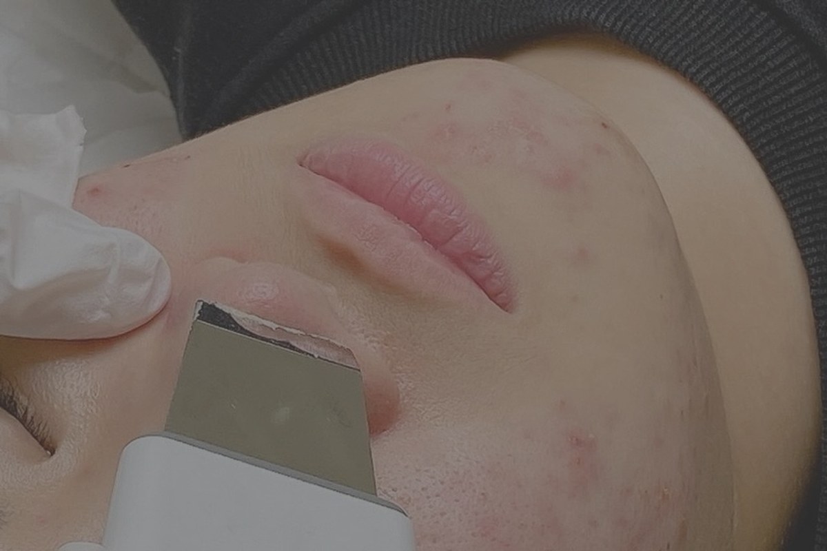 1:1 Hands-On Acne Care Program