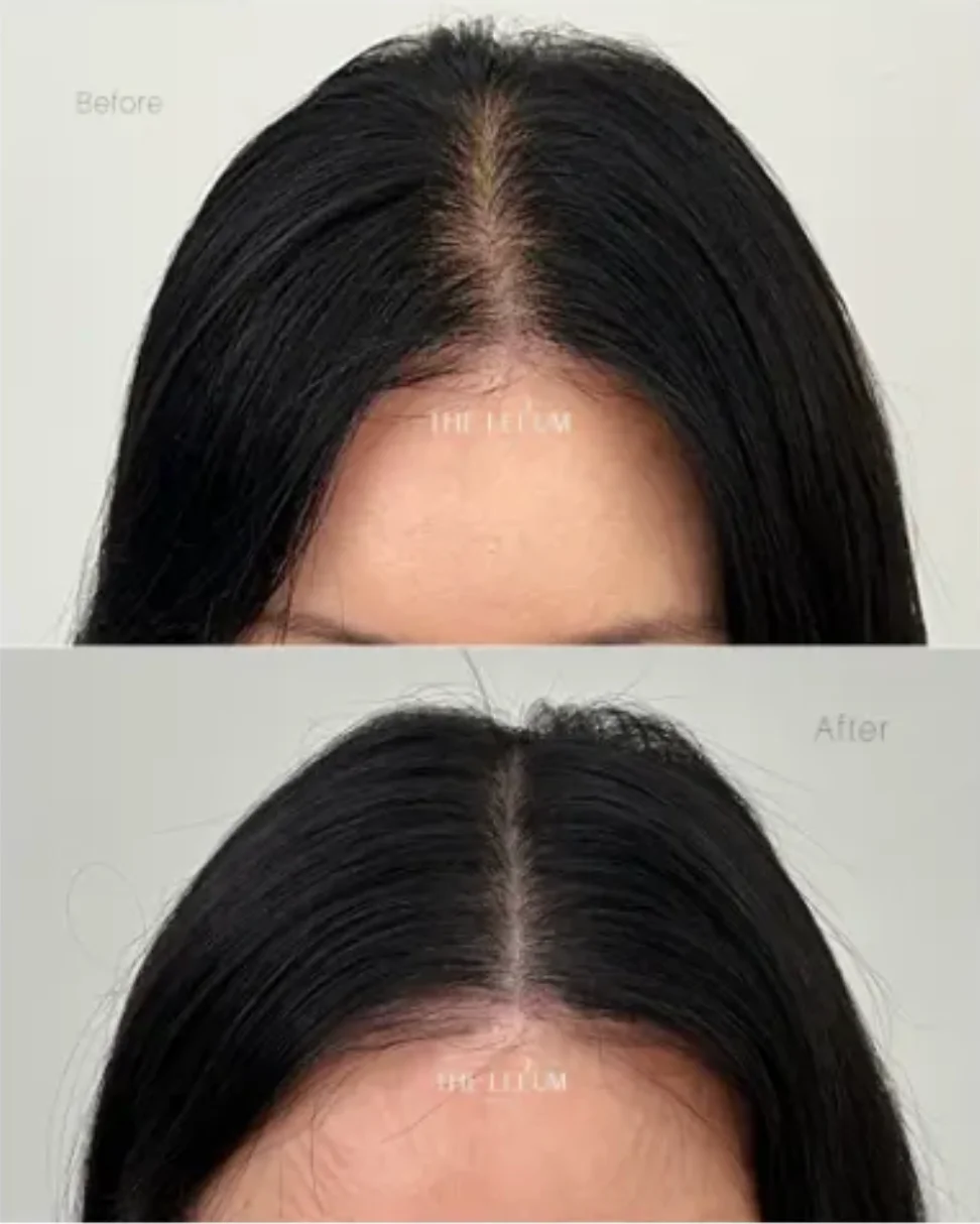 Scalp Tattoo – Part Line / Crown Area(1st Session) 2