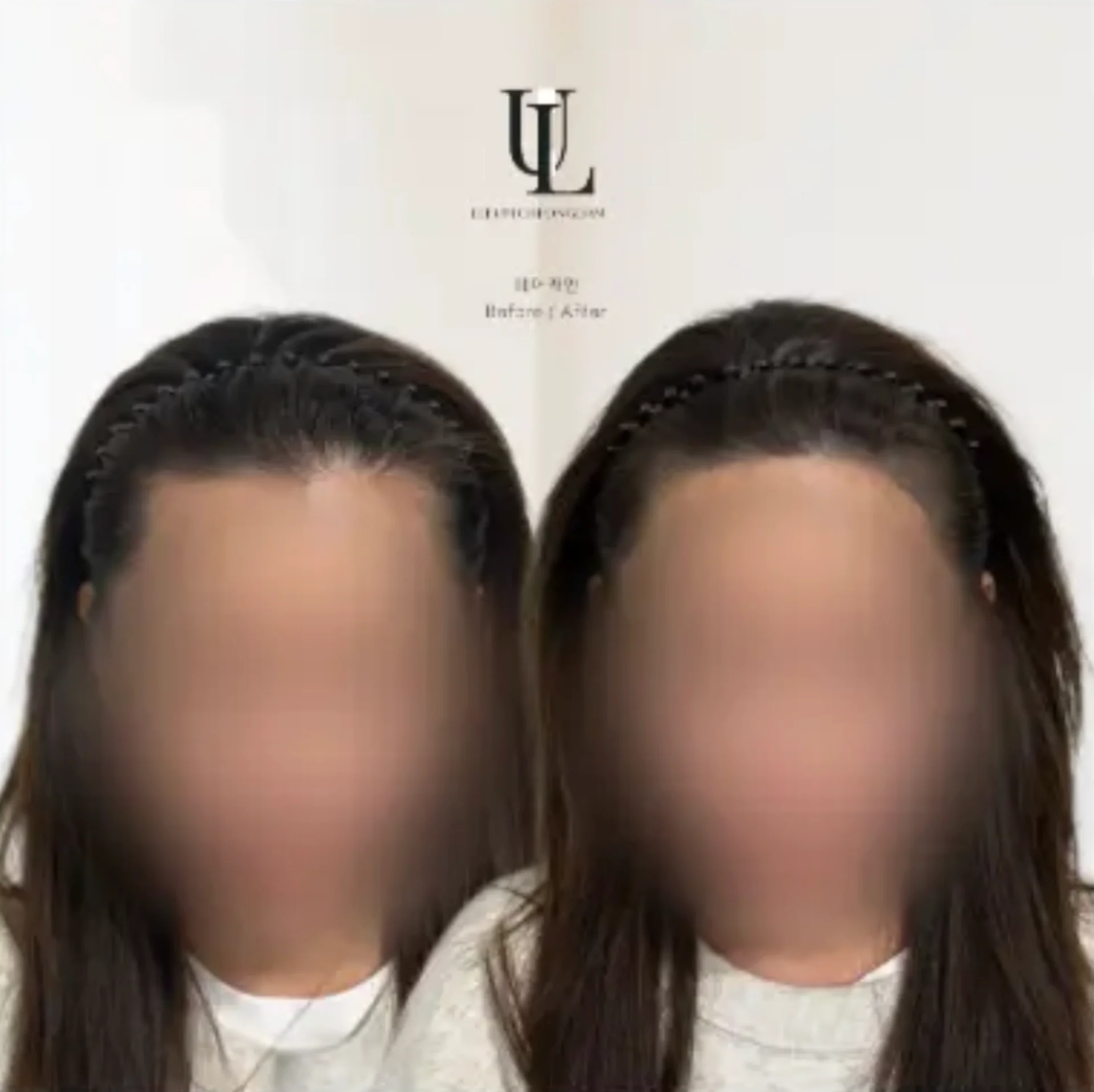 Scalp Tattoo – Hairline 2