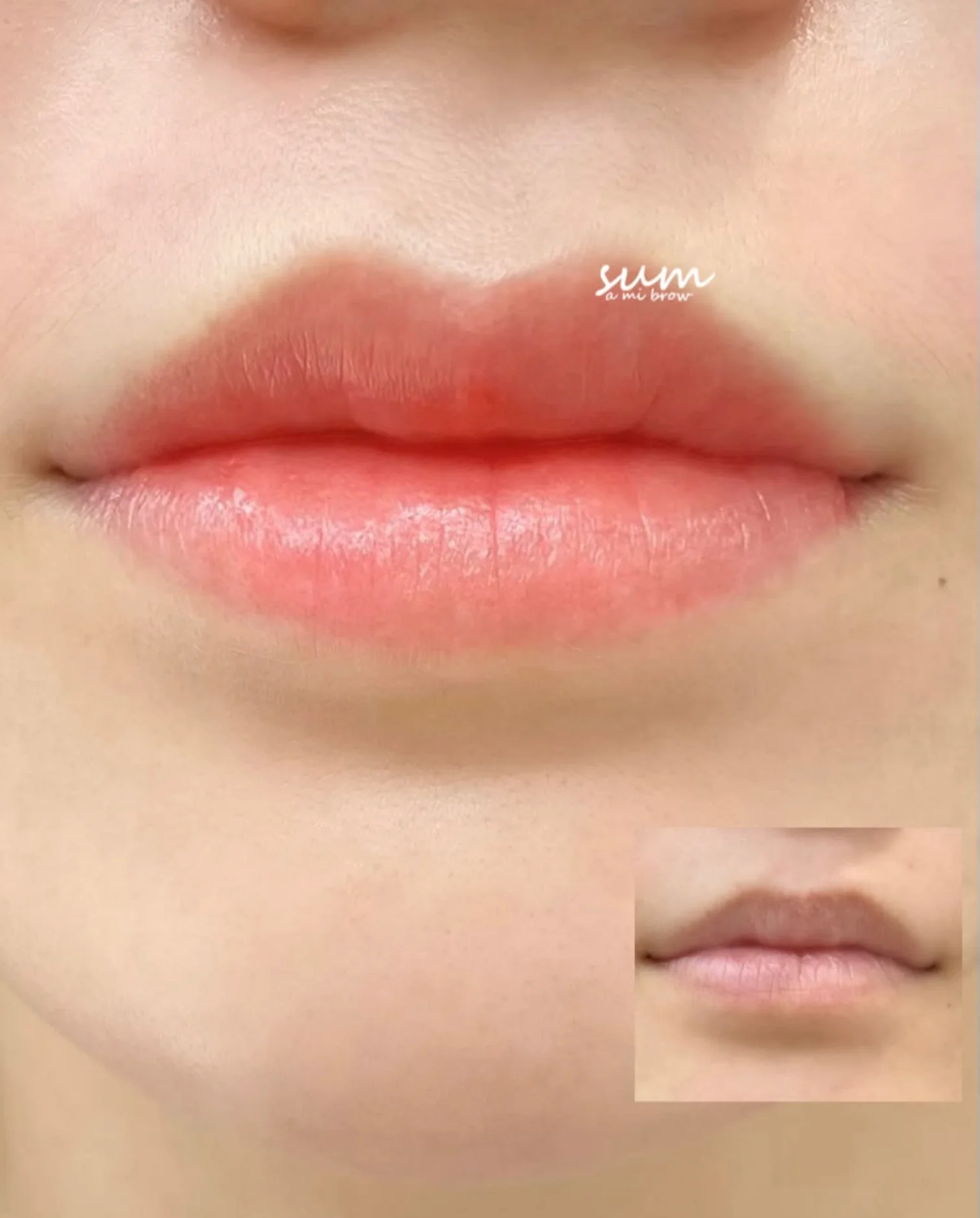 Lip Enhancement 1