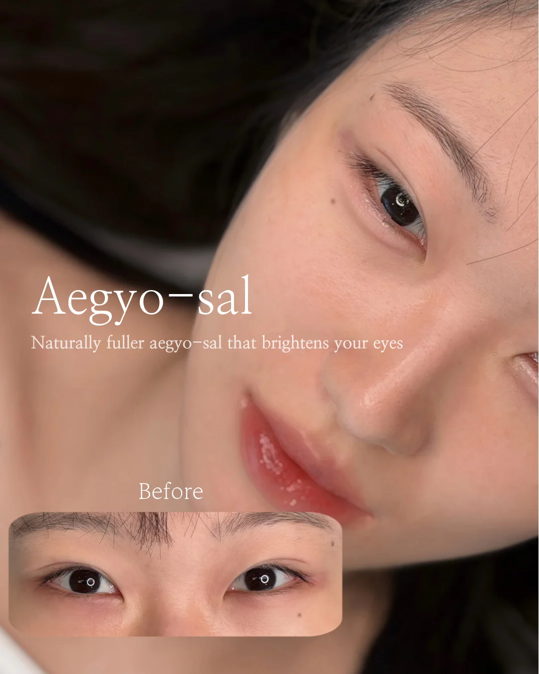Under-Eye Aegyo-sal 1