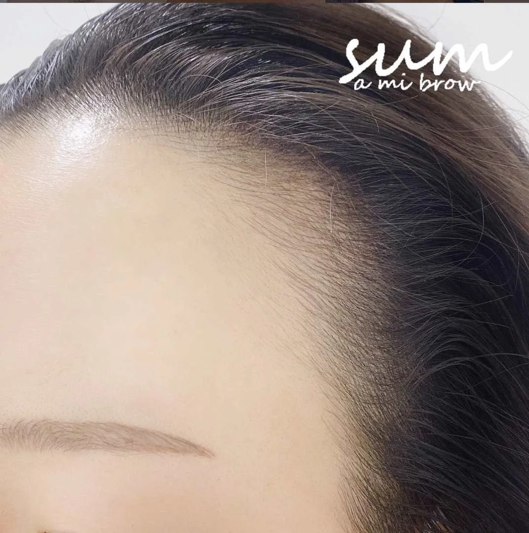 Hairline Enhancement 3