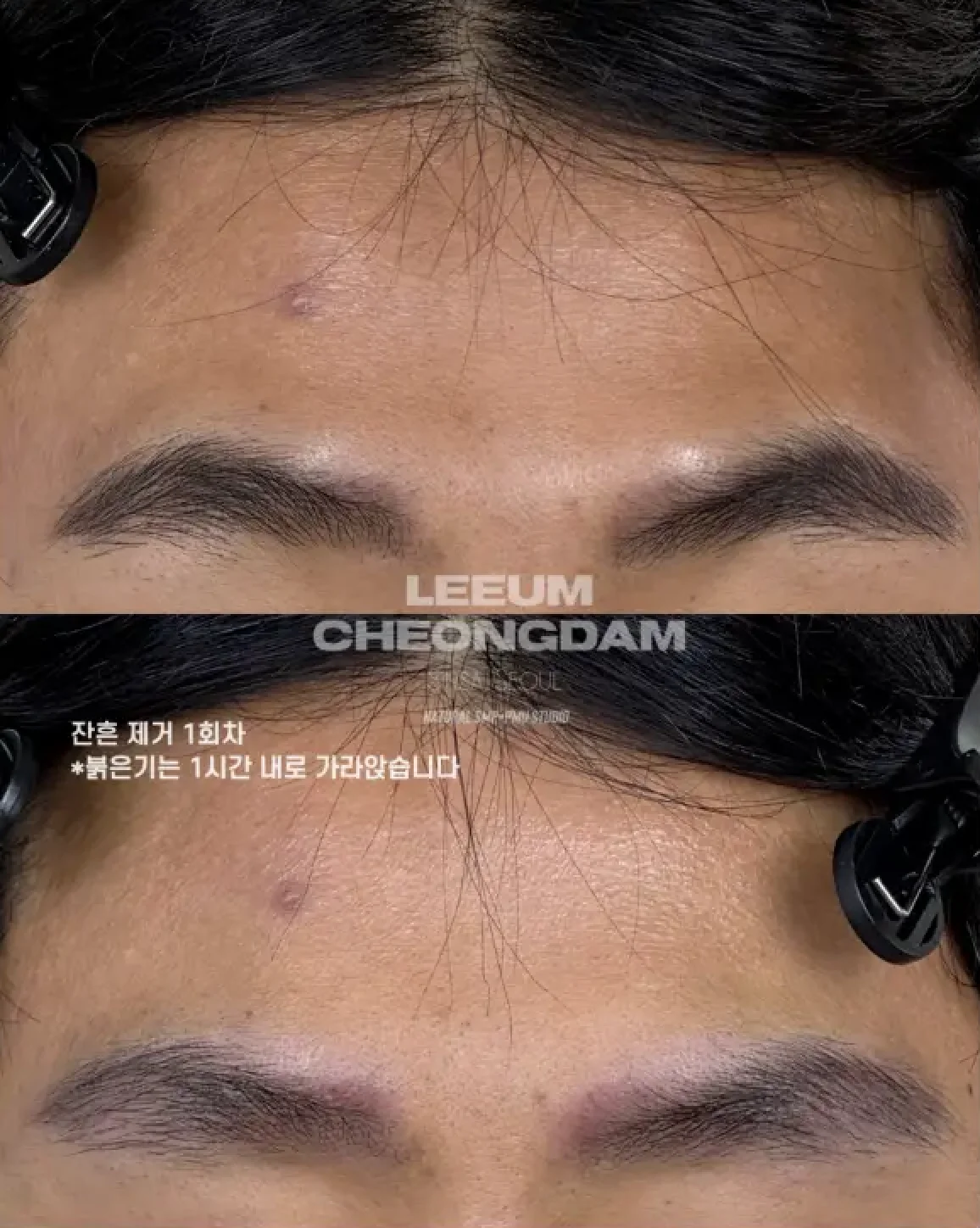 Previous Tattoo Removal (Brow PMU Residue) 2
