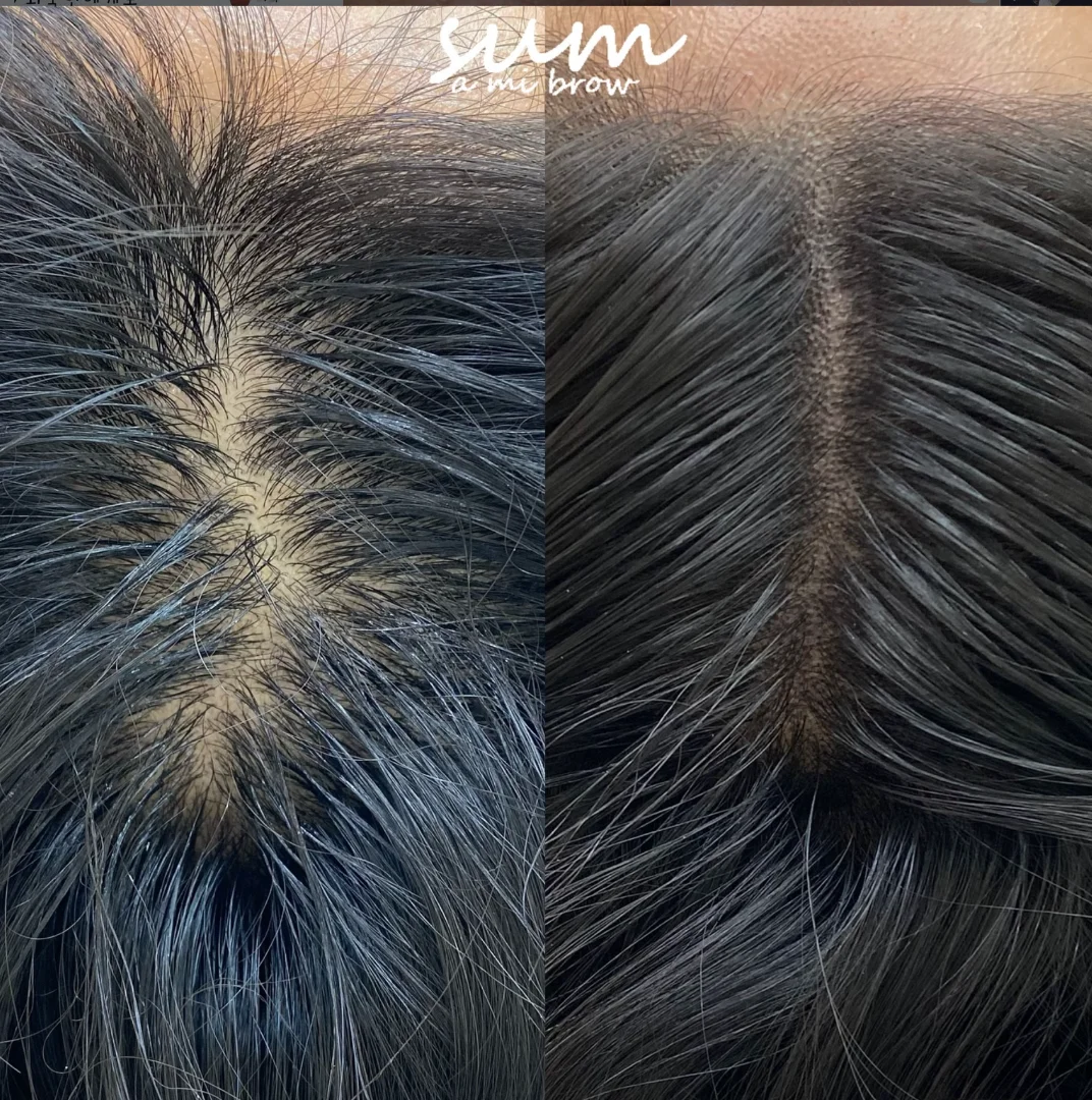 Scalp Micropigmentation (SMP)  3