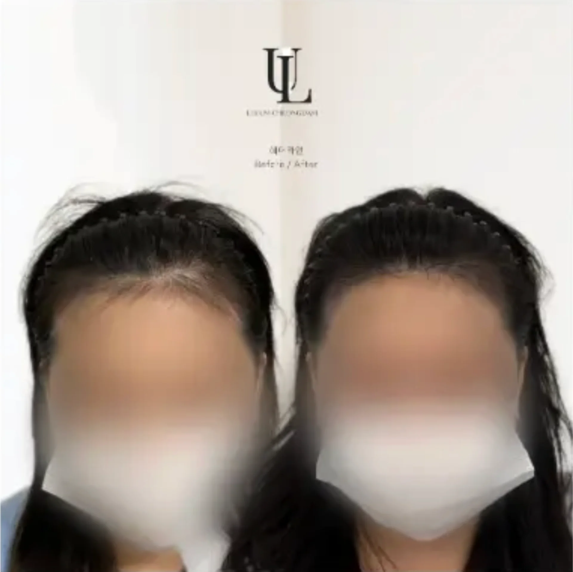 Scalp Tattoo – Hairline 3