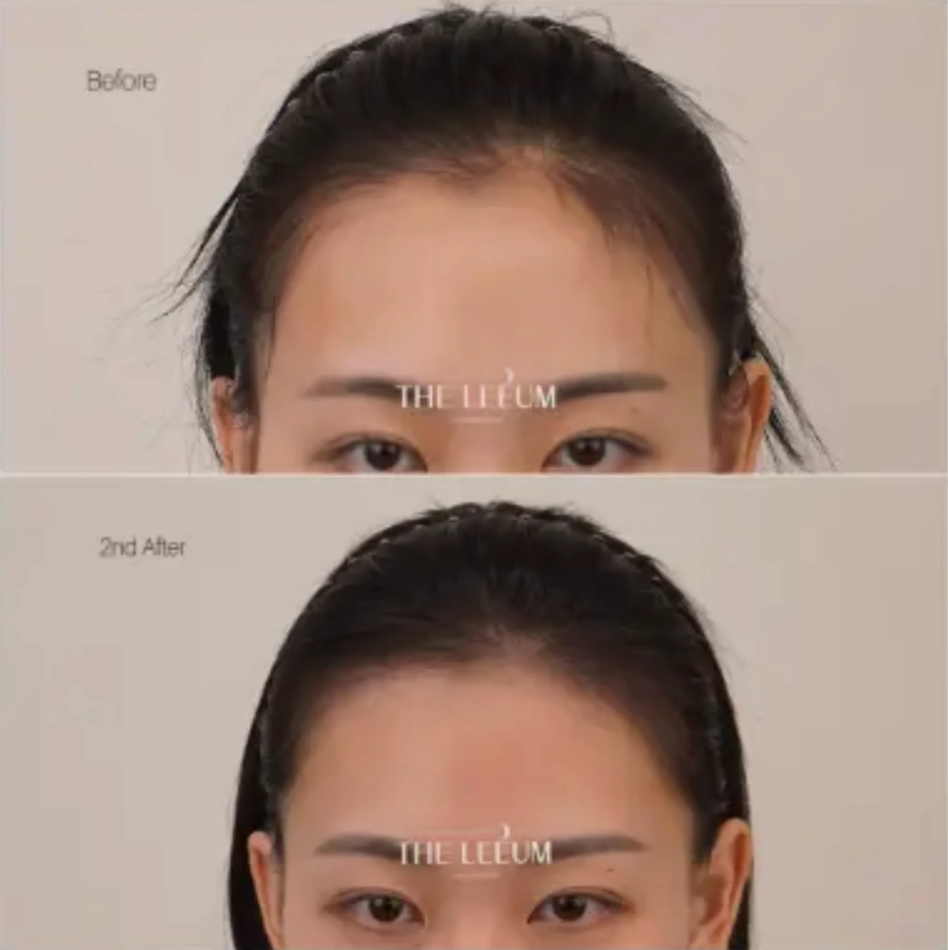 Scalp Tattoo – Hairline 1