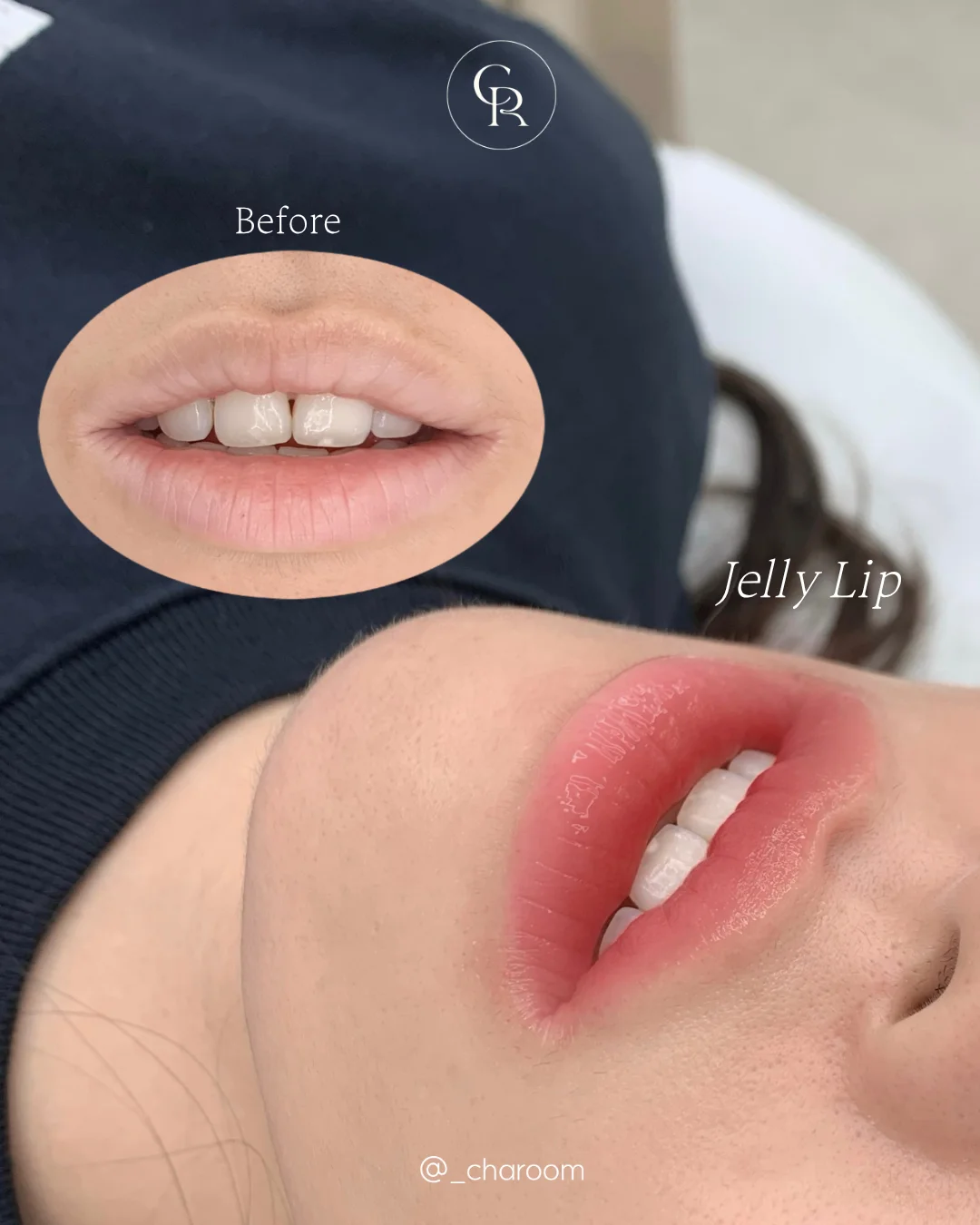 Jelly Lip 4