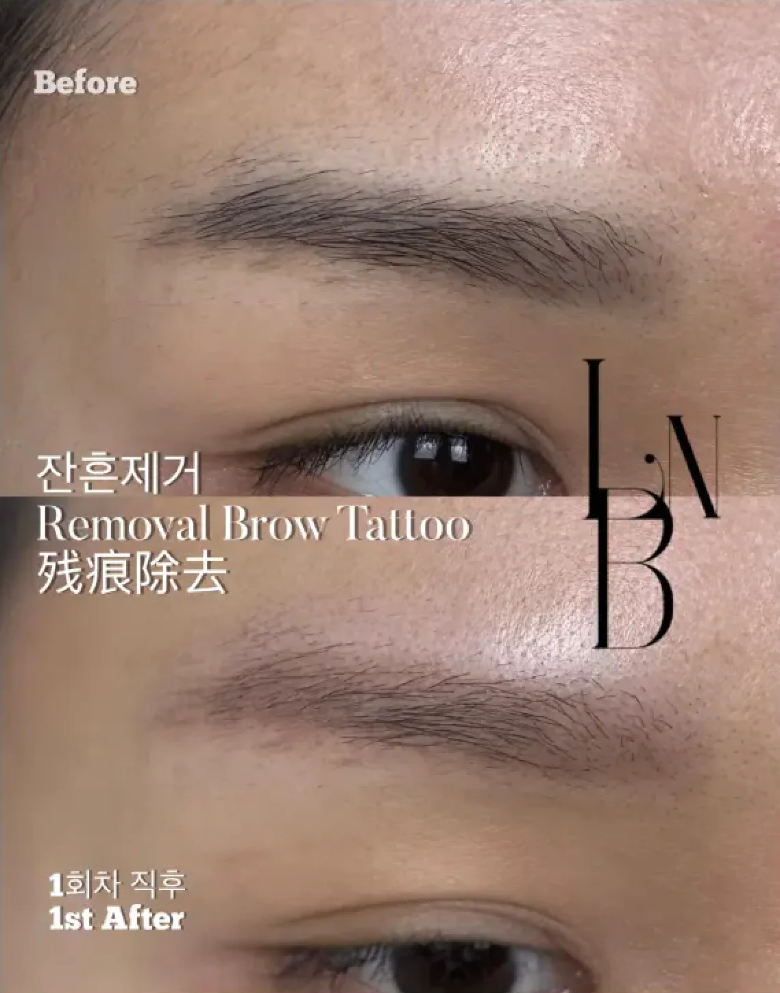 Previous Tattoo Removal (Brow PMU Residue) 1