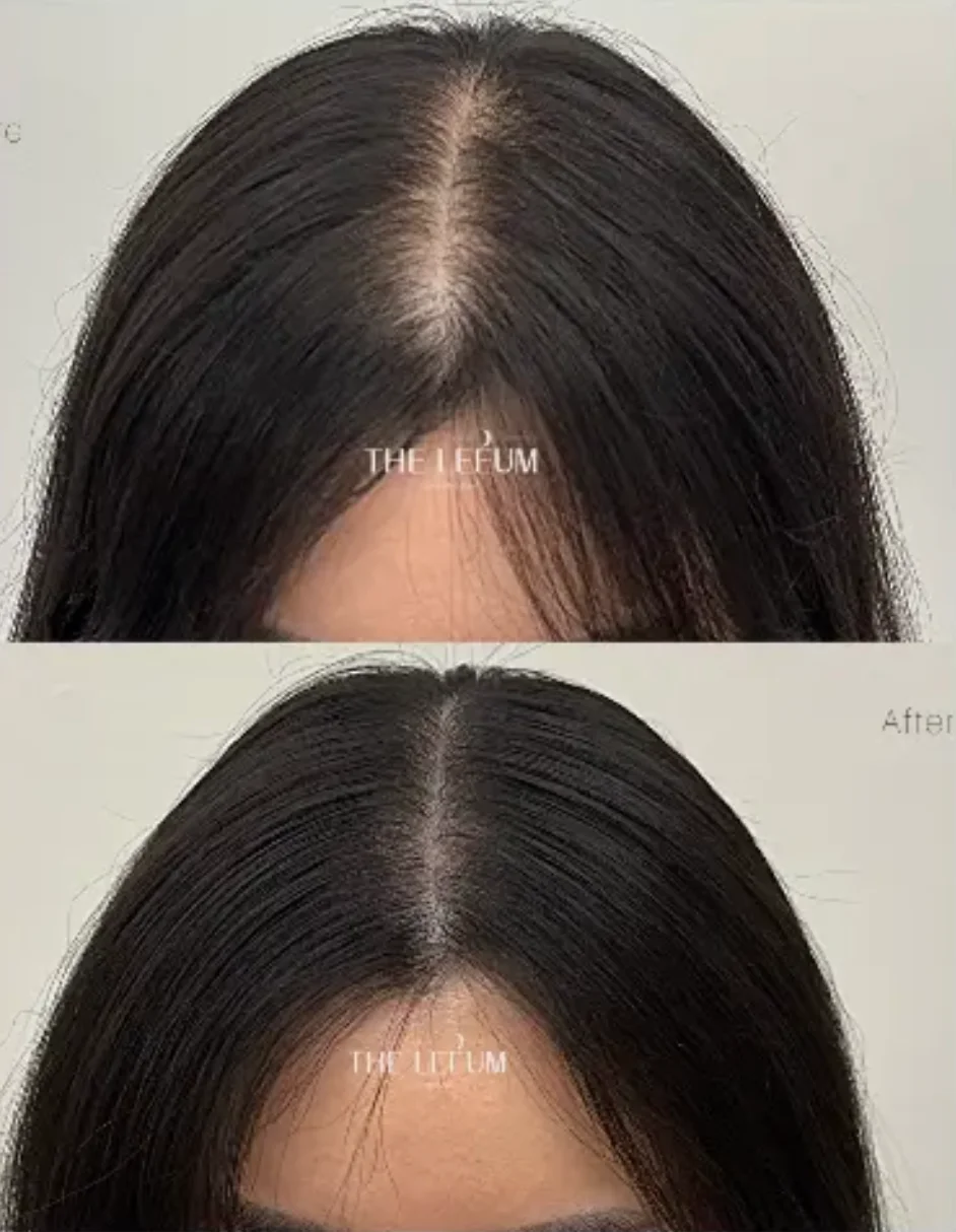 Scalp Tattoo – Part Line / Crown Area(1st Session) 1