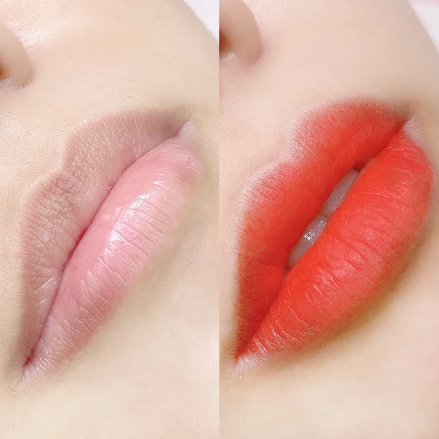 Lip Enhancement 3
