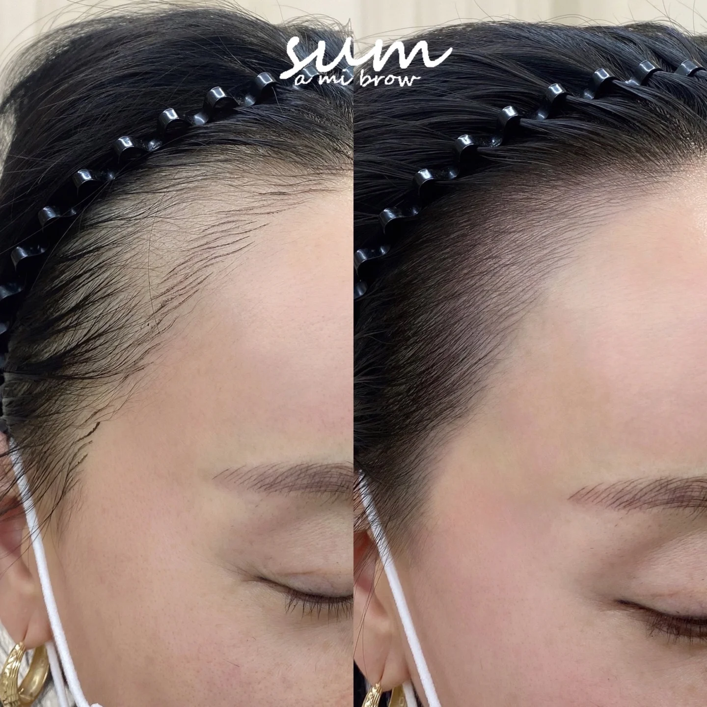 Hairline Enhancement 2