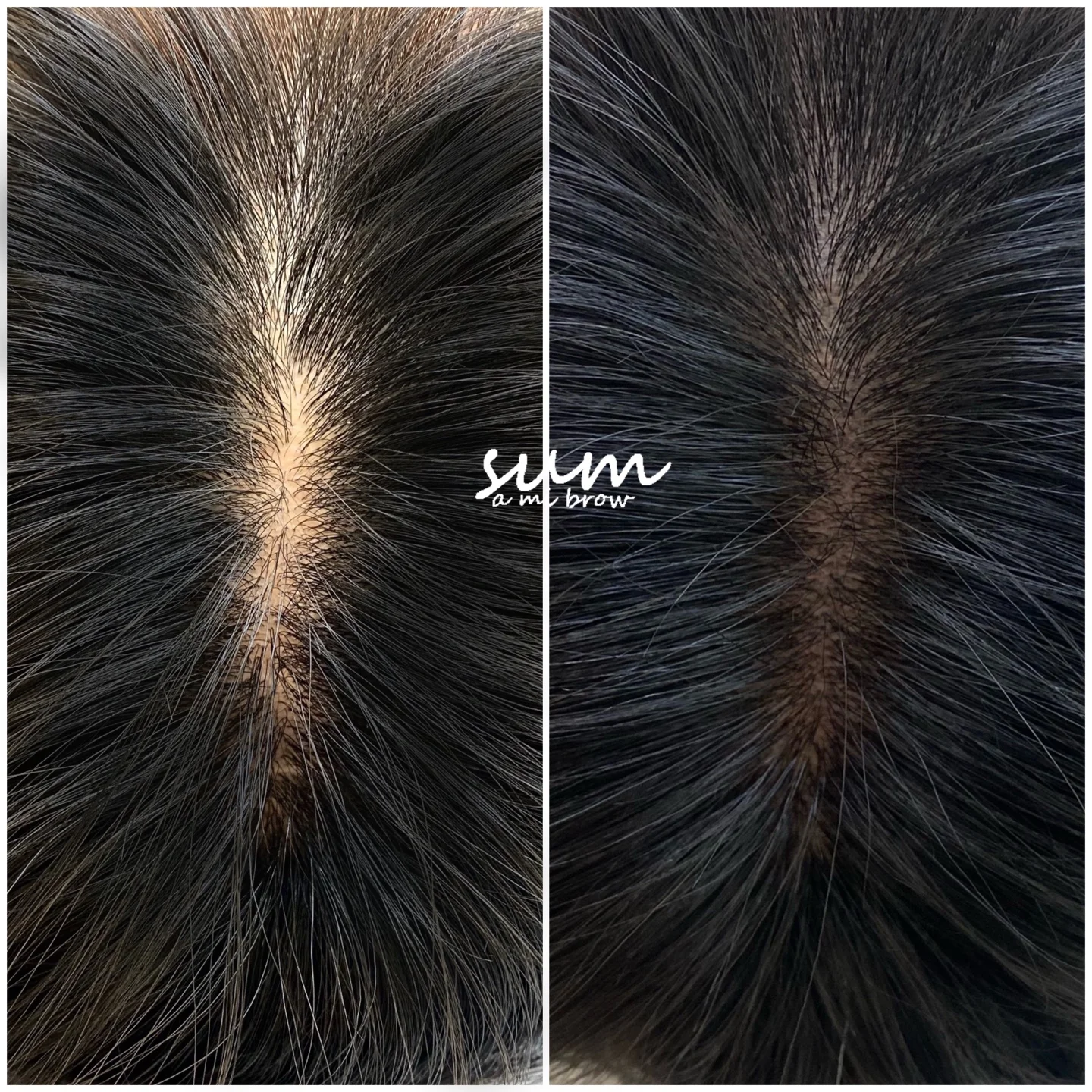 Scalp Micropigmentation (SMP)  2