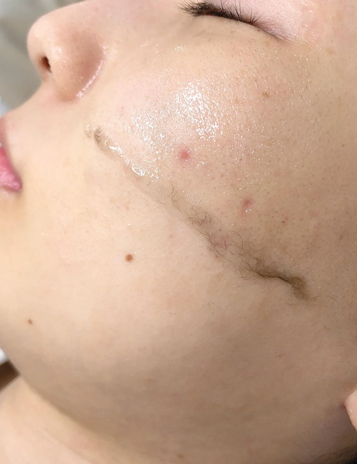Skin Planing (Dermaplaning)  3