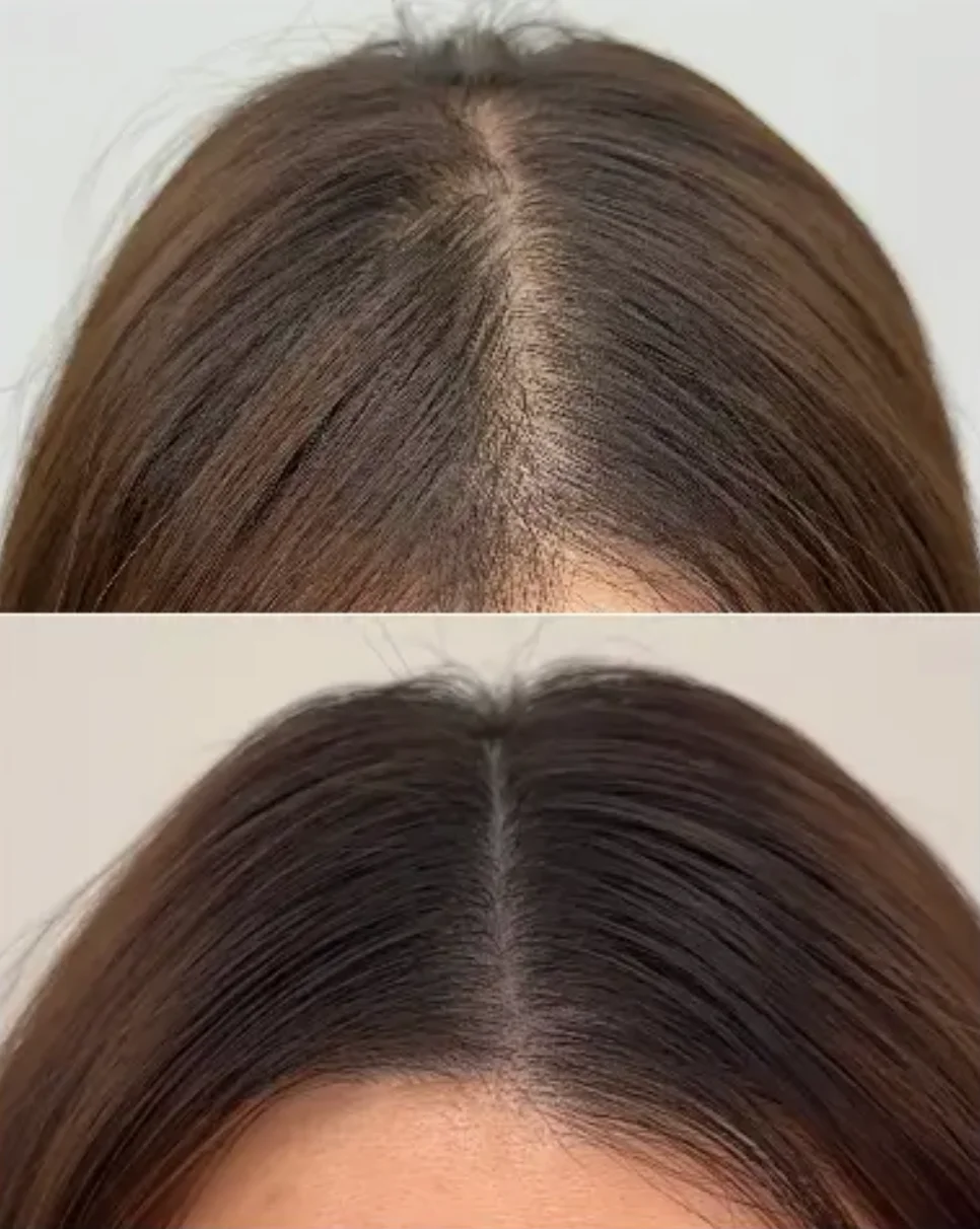 Scalp Tattoo – Part Line / Crown Area(1st Session) 3