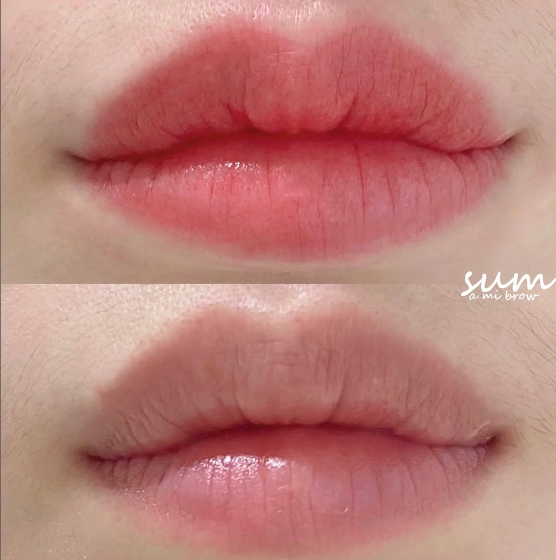 Lip Enhancement 2