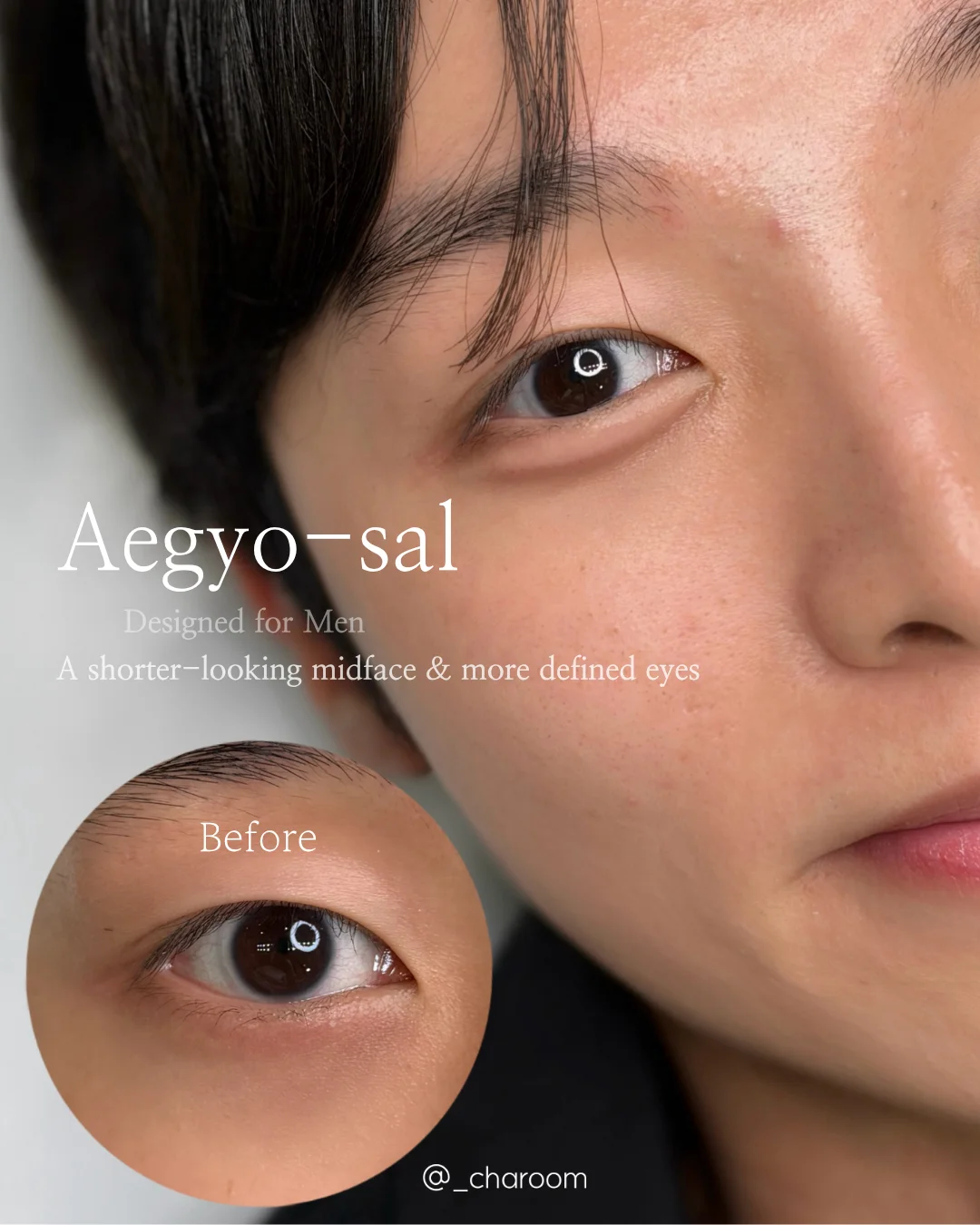 Under-Eye Aegyo-sal 2