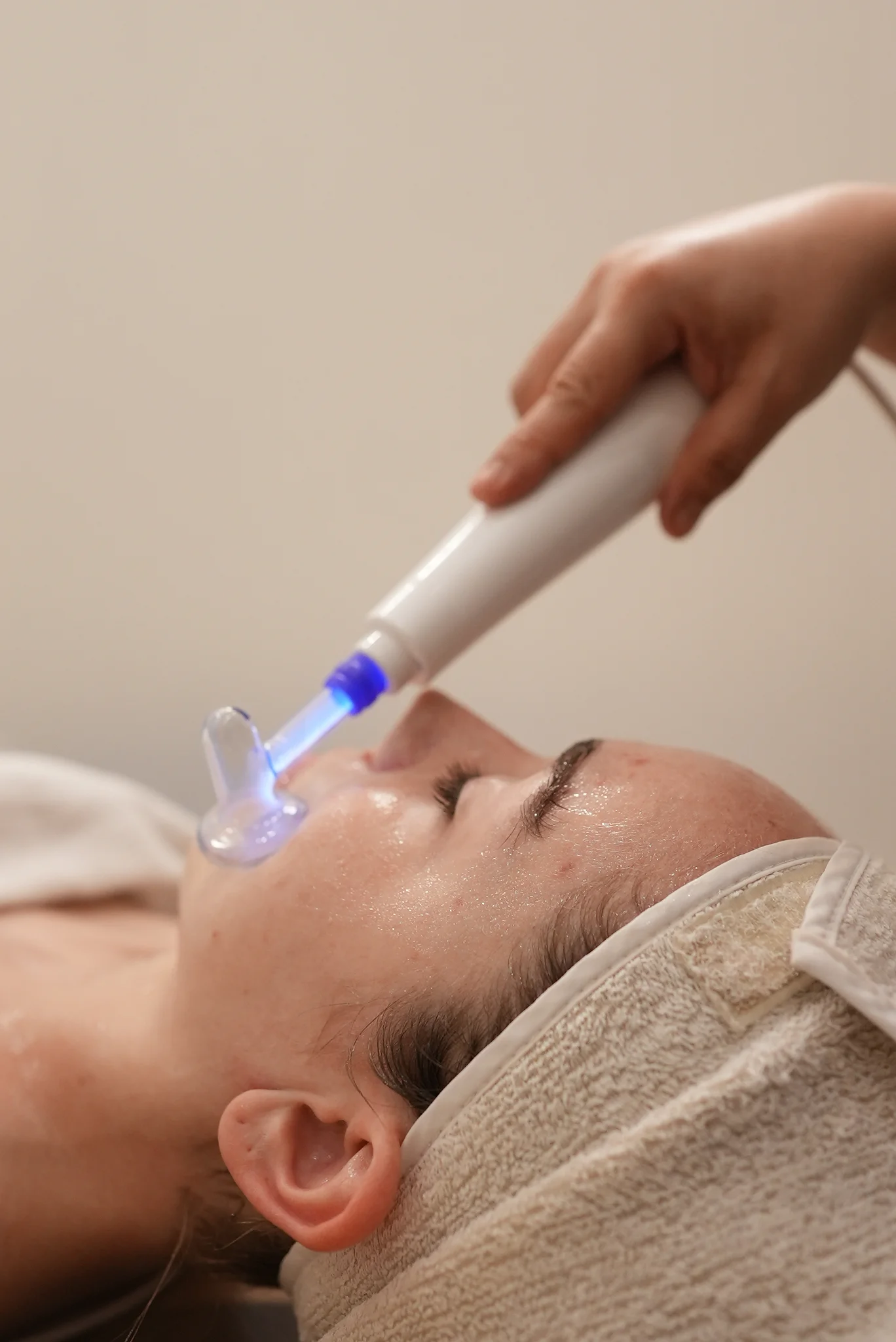 Dual Plasma Acne Treatment (1 Body Part or Face Care) 1