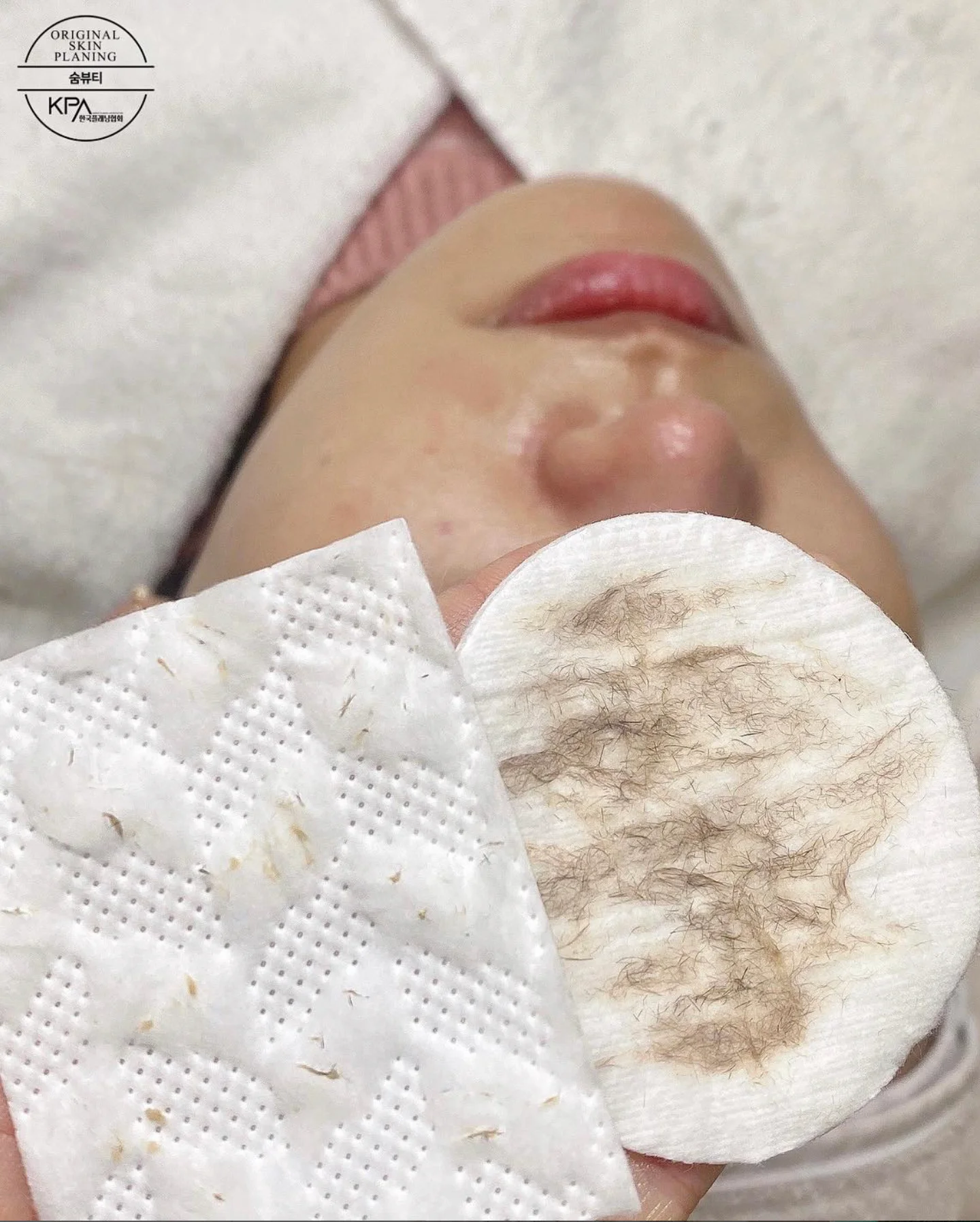 Skin Planing (Dermaplaning)  1
