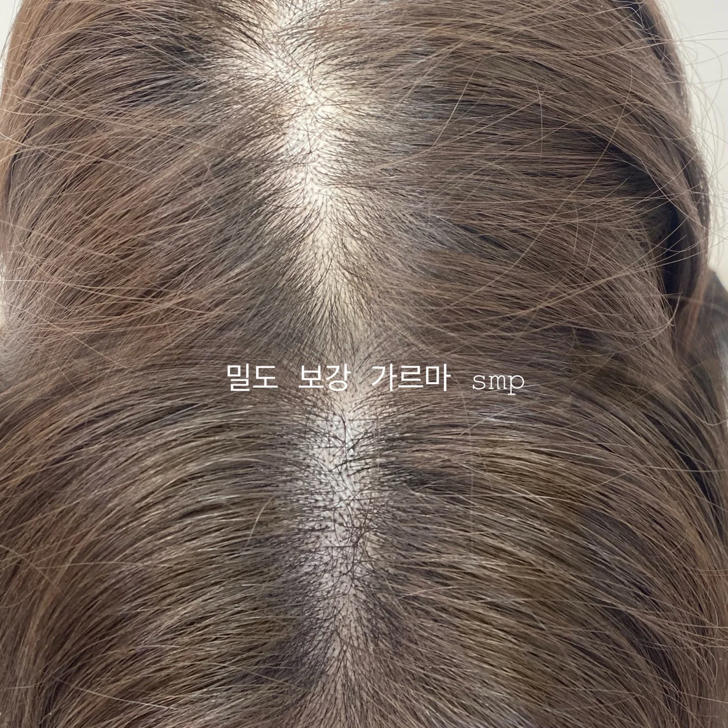 Scalp Micropigmentation (SMP)  1